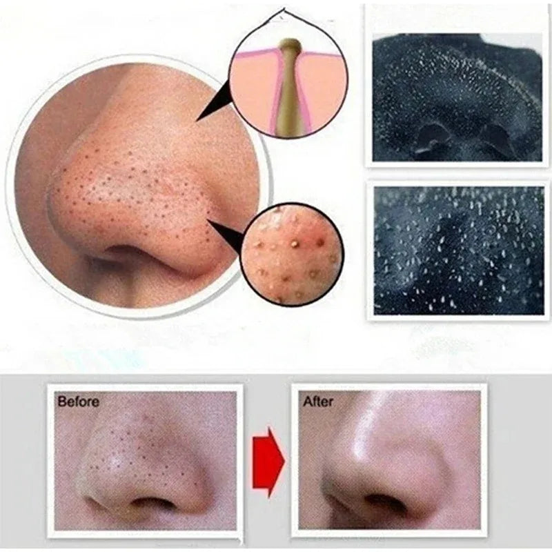 Before and after comparison of skin treatment on a nose with close-up details.