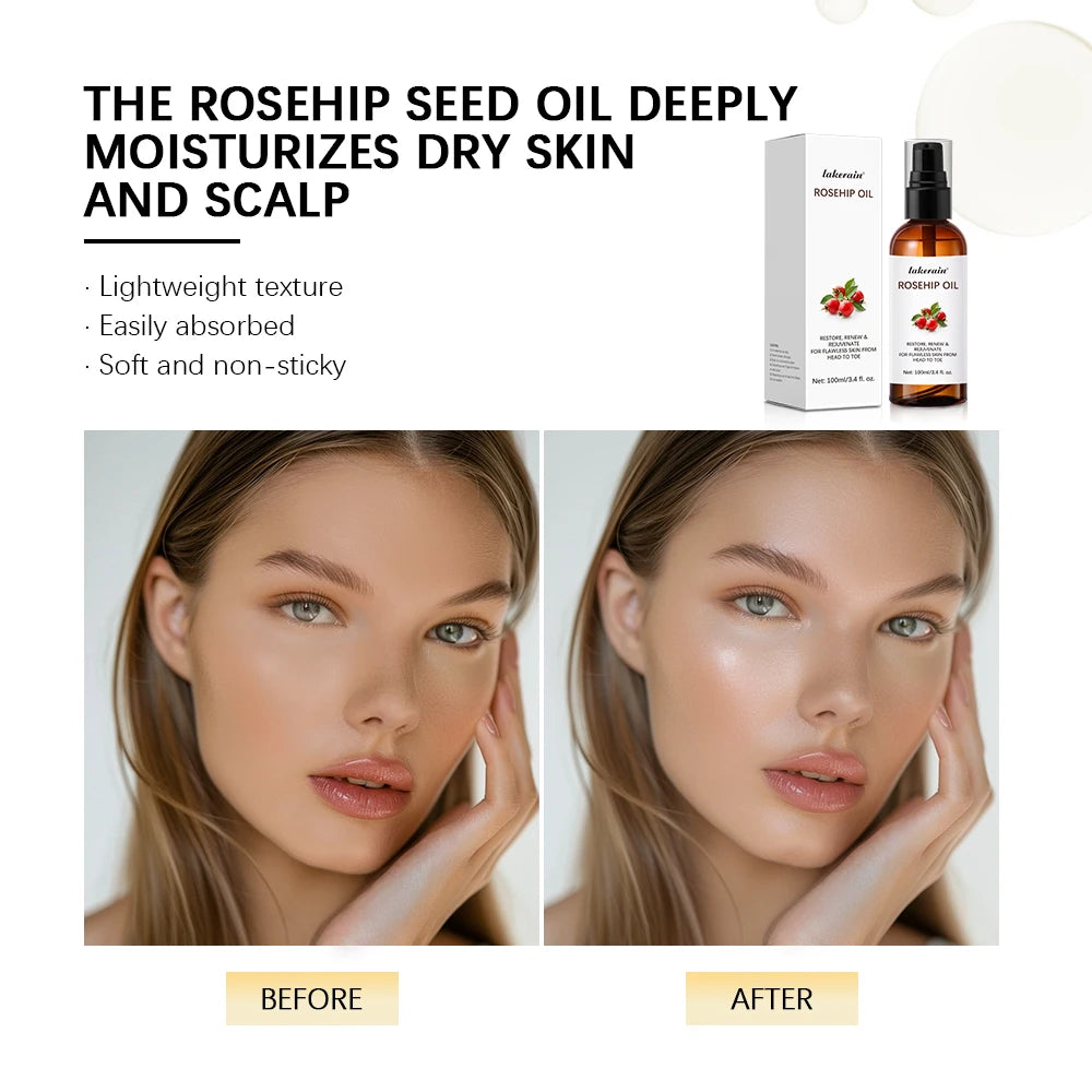 Lakerain Rosehip Oil 100ml – Anti-Ageing, Scar Treatment & Moisturising Face Oil